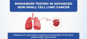 Biomarker Testing In Advanced Non-Small Cell Lung Cancer