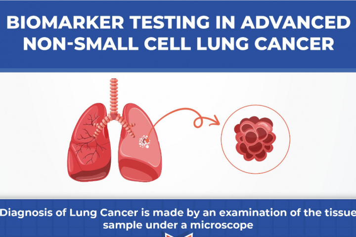 Biomarker Testing In Advanced Non-Small Cell Lung Cancer